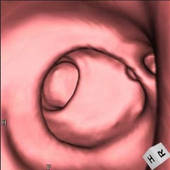 仮想内視鏡の例 大腸憩室(凹んで見える部位)もわかります。